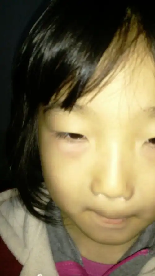 7岁小孩眼袋起水泡能自行消退但是会反复再起