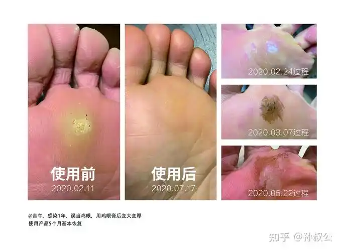 鸡眼贴贴不好的鸡眼最终是怎么好的