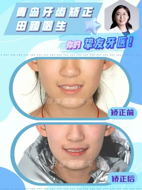 抚平尖尖小虎牙喜提73嘴角甜美小括号