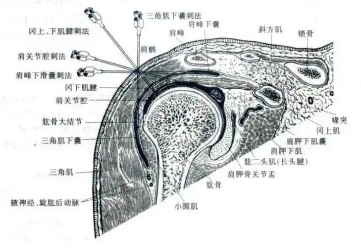 在肩关节上由于三角肌外侧部分收缩,形成两个窝,前方的一个位于肩峰与