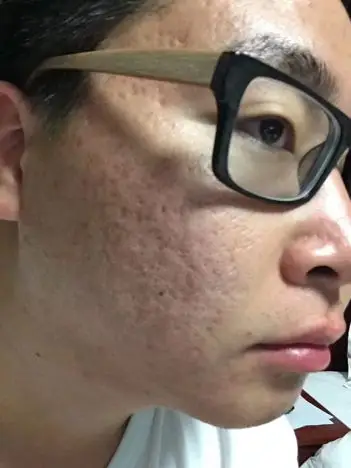 求教,这是什么类型的痘坑? 怎么修复好