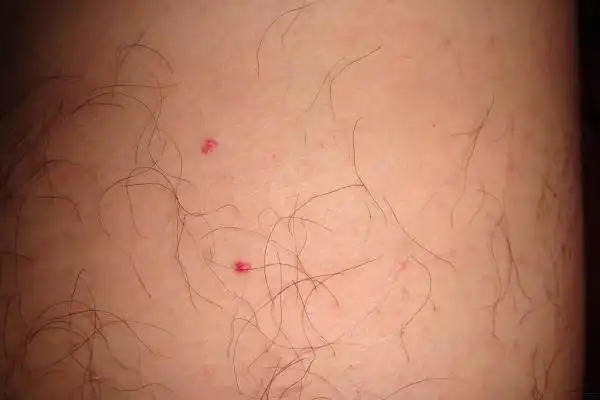 典型皮肤红点,求助!