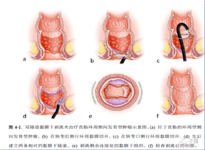 "大肠癌防治 结直肠esd演示"学习笔记(2020广东省中医消化年会)
