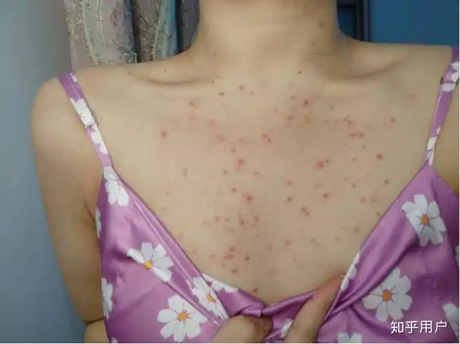 女生胸前长痘痘是什么原因