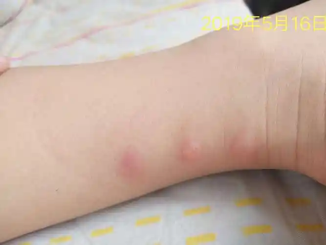 丘疹性荨麻疹偏方_丘疹性荨麻疹 偏方_丘疹性寻麻疹偏方