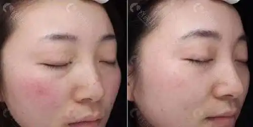 光子嫩肤祛红血丝前后对比图