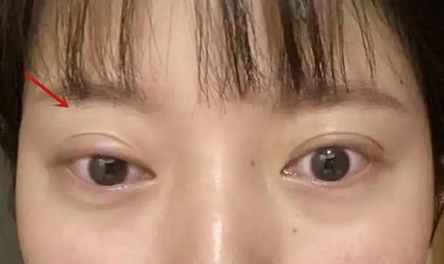 眼睑下垂大约多少钱做上睑下垂矫正手术是一种什么体验呢