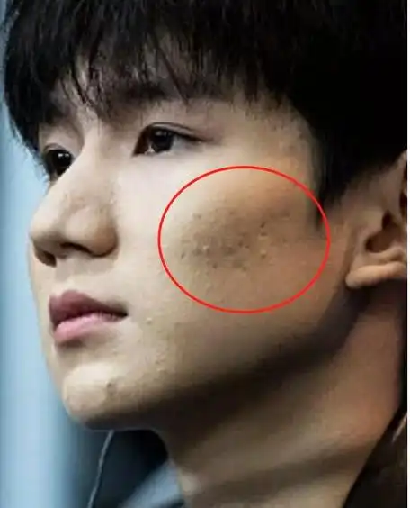 王源高调参加米兰时装周,满脸痘痘惹争议,满脸憔悴被吐槽芙蓉王