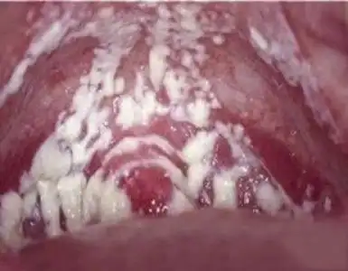 2,稀薄脓性,黄绿色,泡沫状,有臭味白带:为滴虫性阴道炎的特征,伴外阴