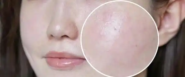 皮肤"外油内干",是屏障出问题了?