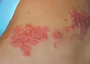 德胜门提倡科学治疗带状疱疹_北京德胜门中医院(皮肤科)