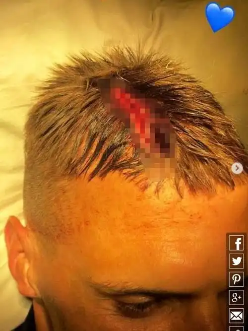 前利物浦悍将血染沙场 头部创口血腥引球迷担忧|费内巴切|斯科特尔