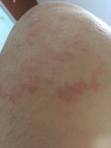 大腿上长了这个,是不是皮肤藓?