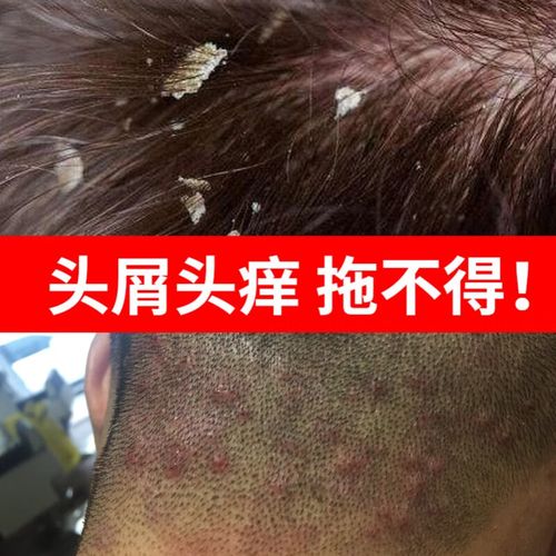 伊芙特去屑溢脂性头皮屑多头痒止痒毛囊有疙瘩炎抑菌洗发水洗液剂 一