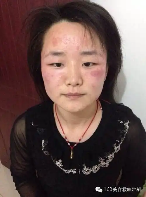 过敏性皮肤,什么刺激性的化妆品都不能用,特别是到了这个季节更