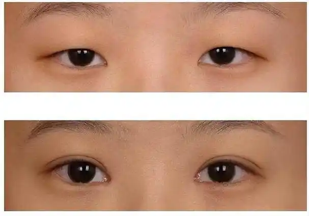 若是做上睑下垂矫正术,需要注意什么?