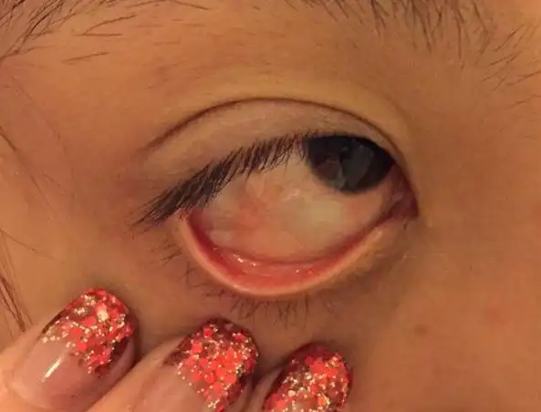 急急急,眼球里面长了一个白色泡泡,起初戴隐形眼镜,眼睛很红,然后点了