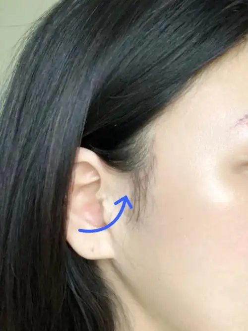 小拉皮术后第203天