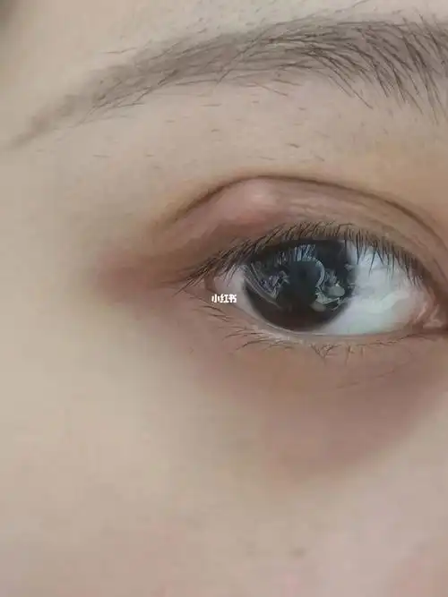 怎么的 就突然发炎了 还长大了 现在好像有个黄豆大了#霰粒肿去检查说