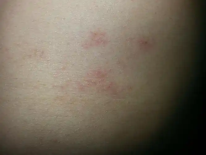 我想问一下我这属于什么皮肤病,一个医生说疥疮,一个医生说湿疹,我