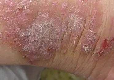 又到季节性湿疹多发季别再让自己遍体凌伤