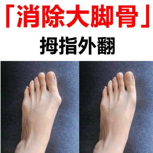 大脚骨矫正器舒骨平消贴拇指外翻日夜用成人女士大脚趾骨拇外翻膏