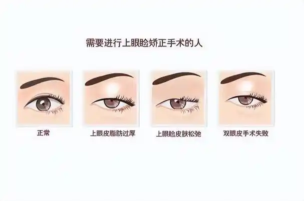 "眼睑下垂"该如何矫正?若是做上睑下垂矫正术,需要注意什么?