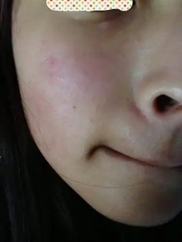 脸上用护肤品过敏怎样快速消除