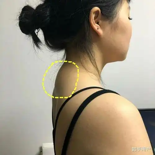 "富贵"逼人,"包" "致"百病|斜方肌|富贵|颈椎_新浪新闻