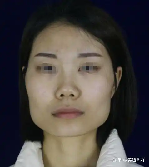 因为方脸脸宽下颌骨肥大而自卑怎么办该不该削骨