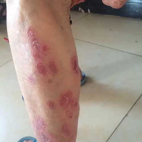 80多岁的老年人莫明其妙长了红斑,像湿疹又不像,红色一大片的,干裂