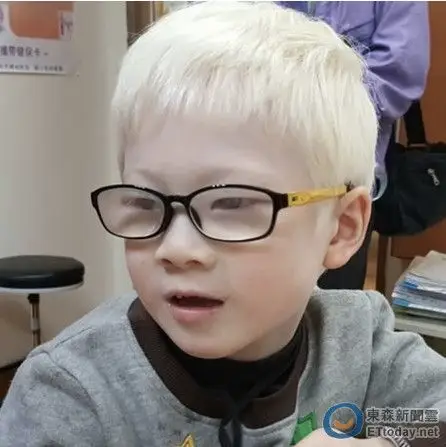 「白化症」造成黄斑部发育不良 5岁男童只剩听力
