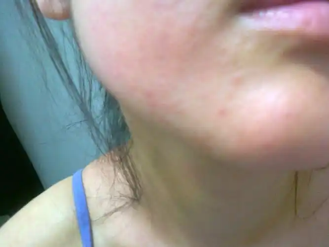 脂溢性皮炎如何才能治愈