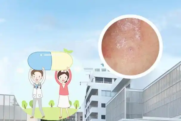 过程,牛皮癣治疗要注意保健,不要盲目治疗,以免导致牛皮癣病情的加重