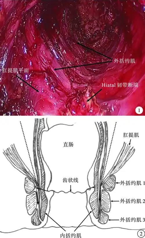 腹腔镜辅助下的低位直肠癌经内外括约肌间切除术直视下的吻合器一期