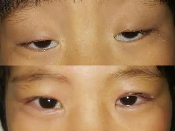 先天性上睑下垂