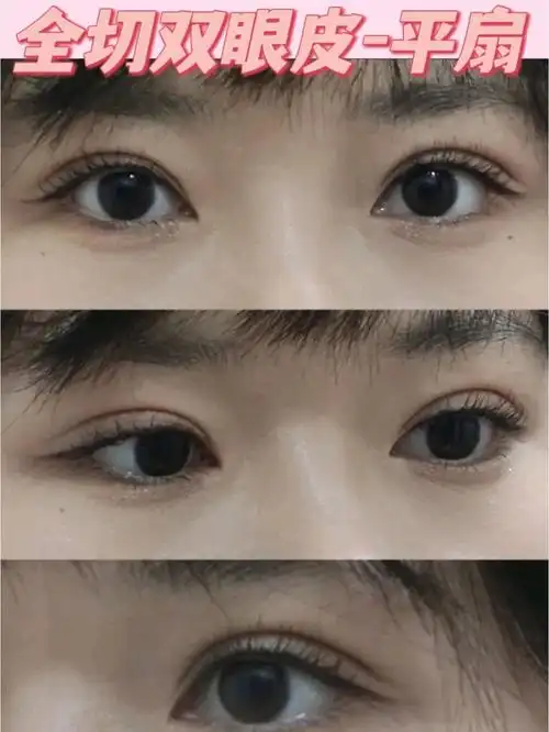 平扇双眼皮分享