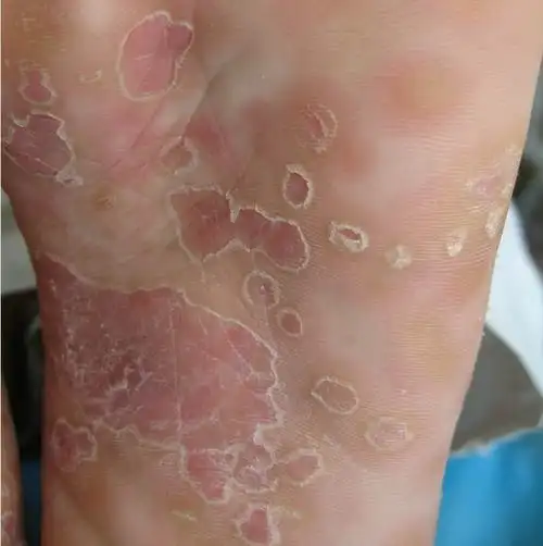 硬下疳初期图片8