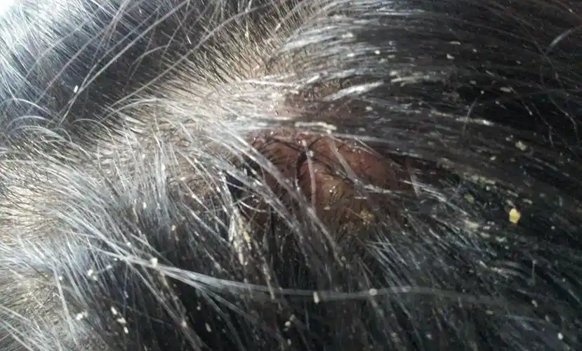 儿童的头癣图片调理头癣头皮屑头痒图片典型病例头癣图片长发白色头癣