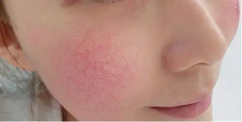 每日一护肤丨红血丝,夏天的缘故吗?