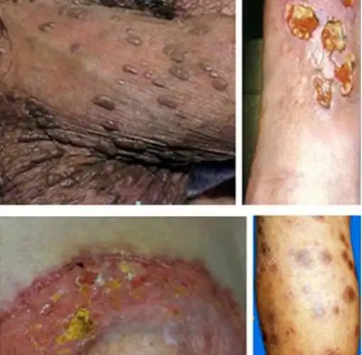 早期梅毒感染症状图图片