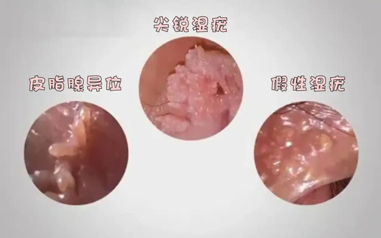 假性湿疣的治疗,其实和我们对待生活中的许多问题一样,需要找到问题