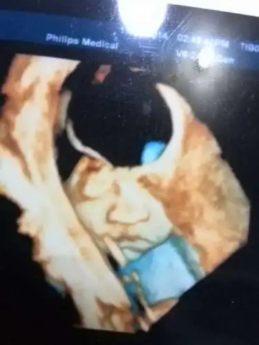 胎宝宝的四维照,大鼻子大嘴巴的感觉有没有