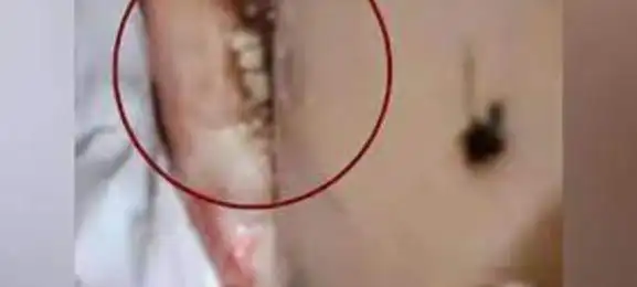 网红小敏甲状腺癌身体长蛆原视频图片小敏来了抗癌背后大洞长虫子图片