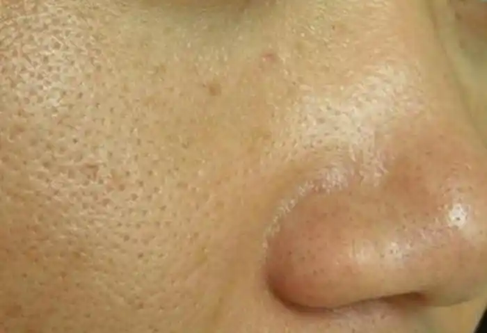 皮肤粗糙怎么保养皮肤粗糙显老怎么办