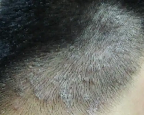 头皮癣早期症状图片5