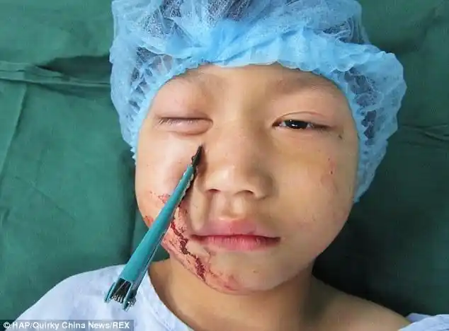 2岁女童摔倒筷子从鼻腔插进眼眶#预防家庭儿童眼外伤!
