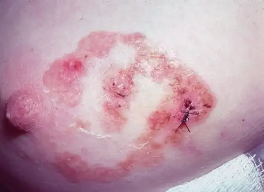 乳房湿疹是怎么引起的 乳房湿疹是怎么引起的 揭秘引