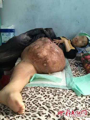 女子左腿长50斤肿瘤