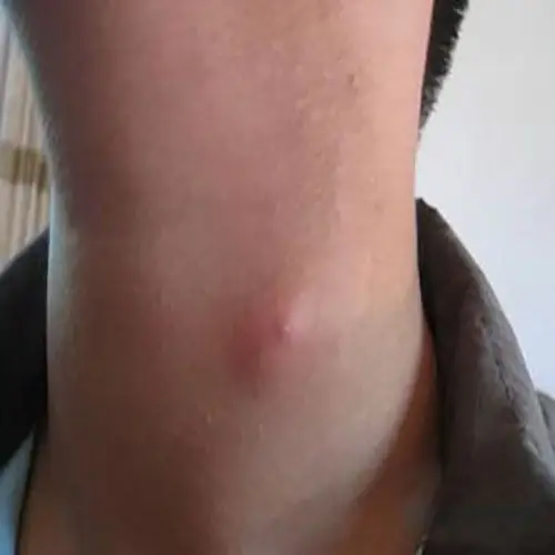 脖子后淋巴结肿大初期症状图片_有来医生